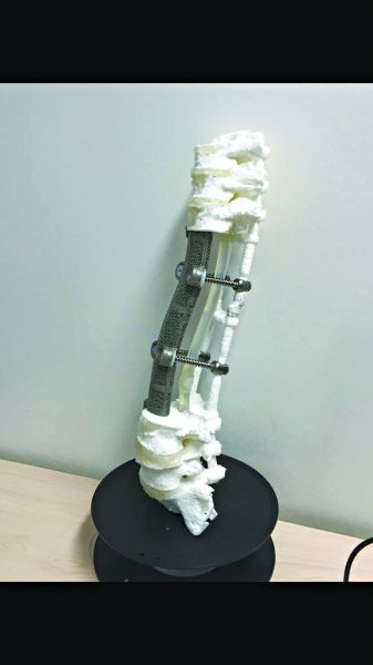 Médicos chineses têm sucesso com implante de vértebra impresso com tecnologia 3D