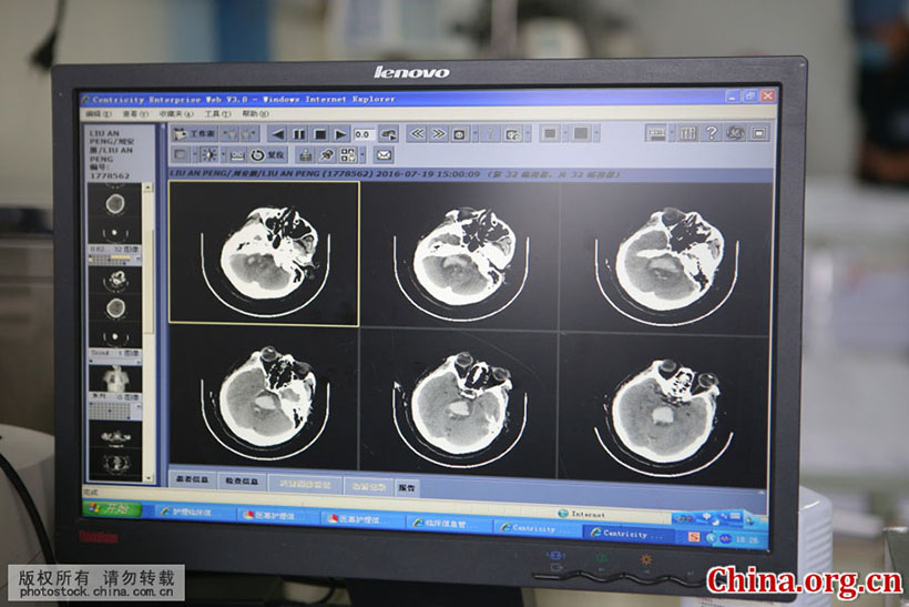 Cirurgia cerebral com tecnologia de impress?o 3D é realizada em Shandong