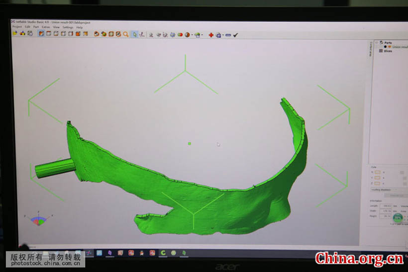 Cirurgia cerebral com tecnologia de impress?o 3D é realizada em Shandong